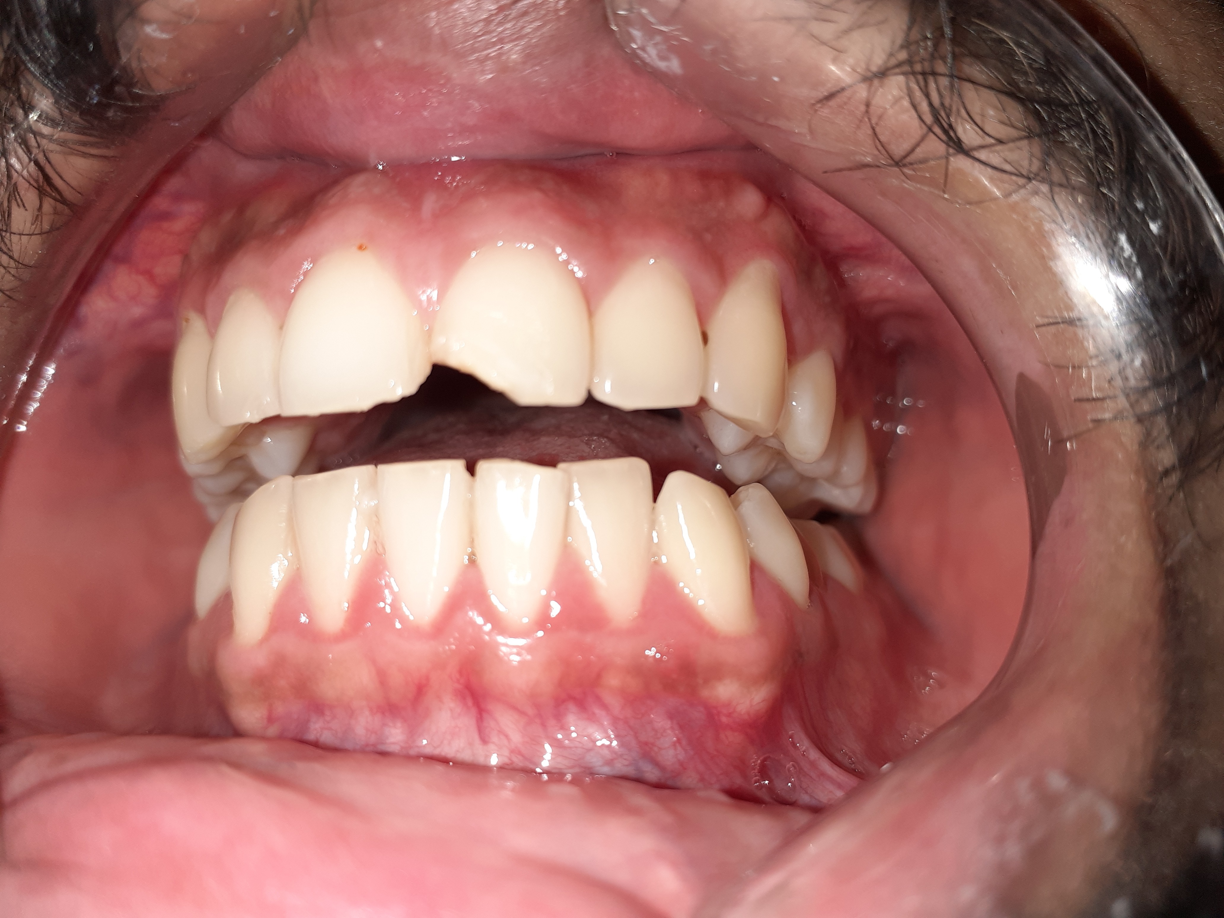 Tooth-Coloured Fillings â€“ before